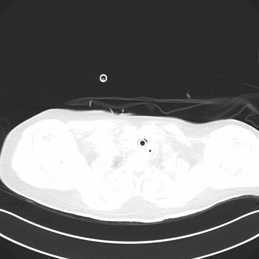 附图2 患者入院后24h胸部CT（2021-06-13）.gif